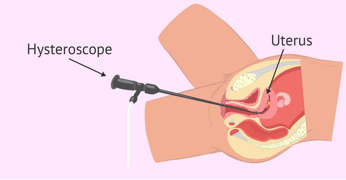 hysteroscopy