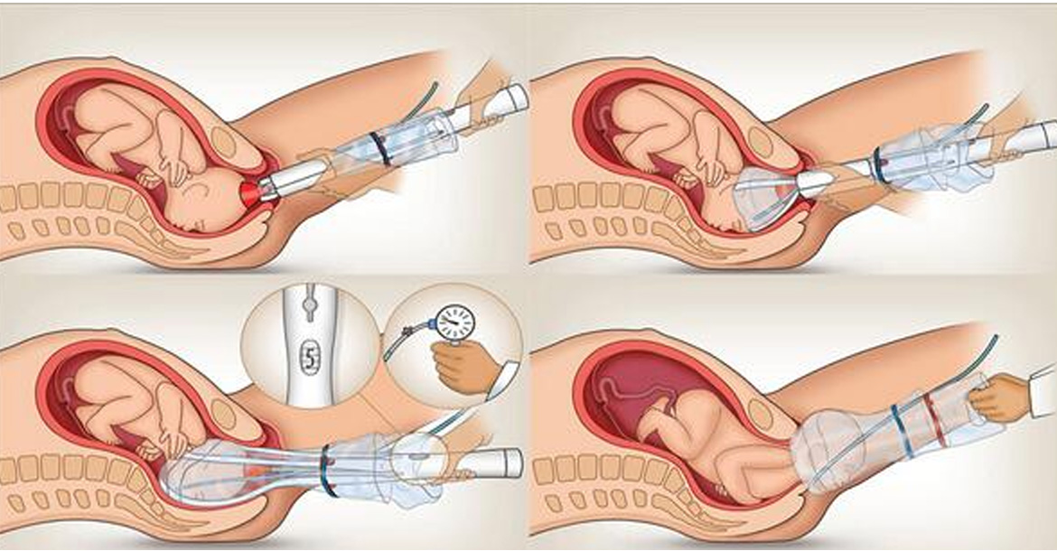 operative-deliveries
